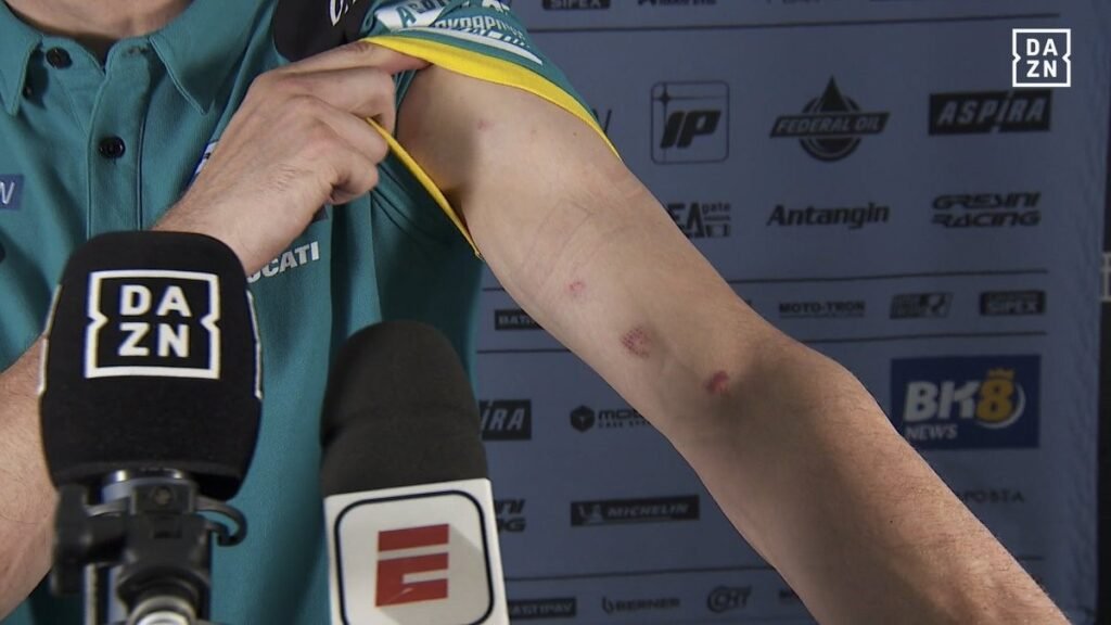 Bezzecchi pudo más que los problemas estructurales 6 Las marcas en los brazos de Alez Marquez