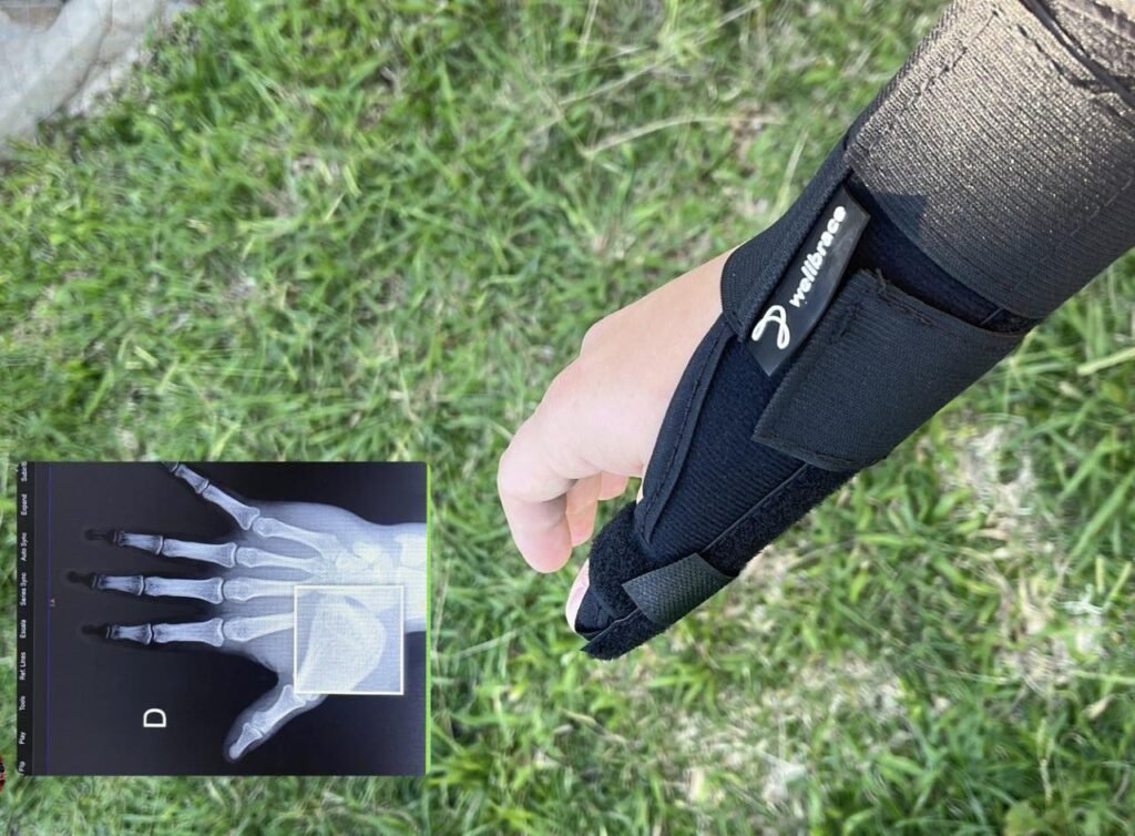 TC Pista: Borgert dice ausente a Neuquén 2 dedo